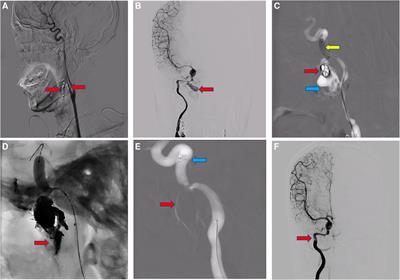 Frontiers Case Report Endovascular Intervention Of Internal Carotid